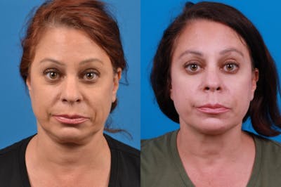 Profile Neck Lift Before & After Gallery - Patient 122406569 - Image 1