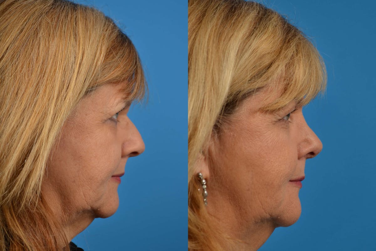 Rhinoplasty Before & After Gallery - Patient 122406570 - Image 1