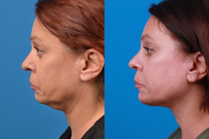 Profile Neck Lift Before & After Gallery - Patient 122406569 - Image 2