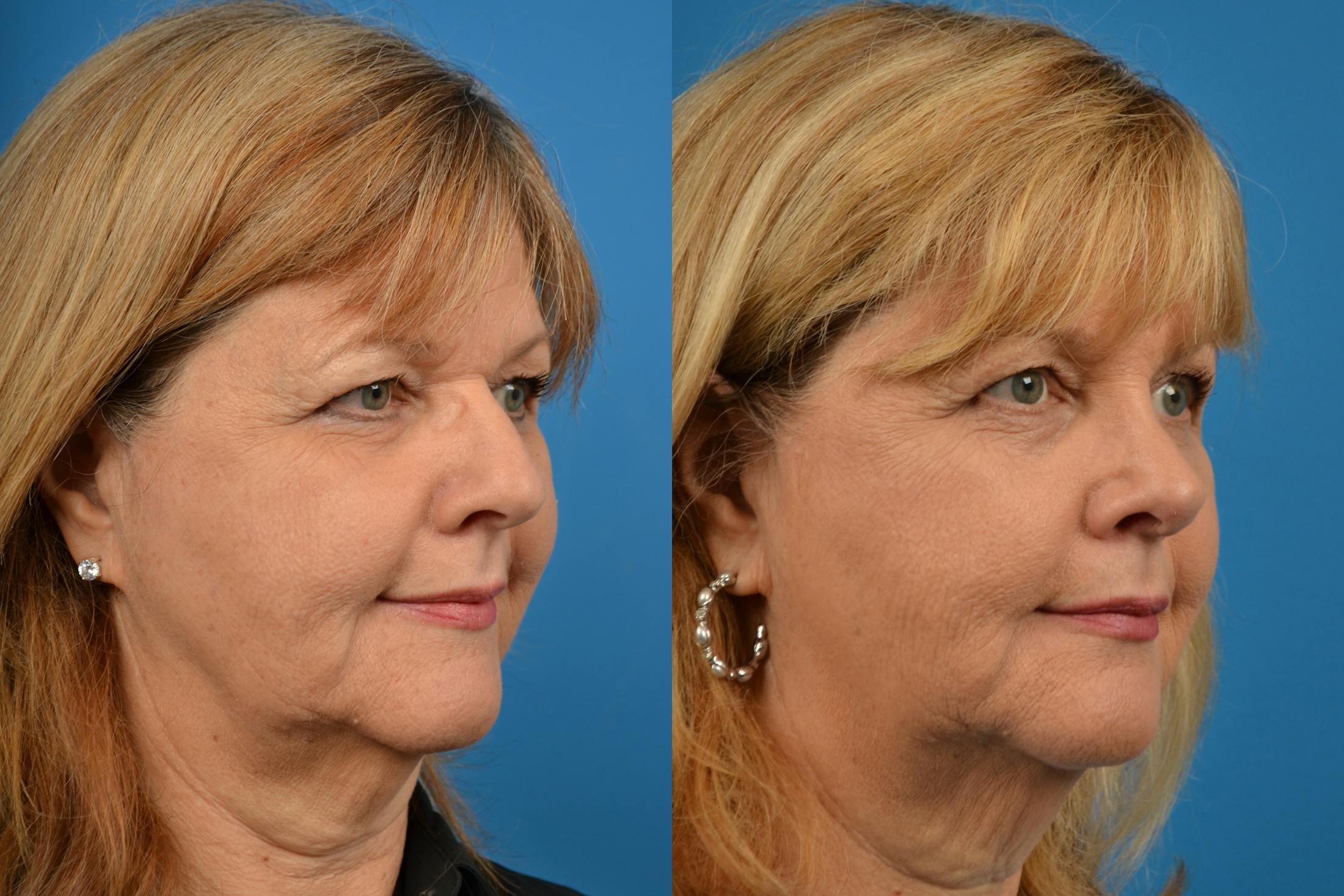 Rhinoplasty Before & After Gallery - Patient 122406570 - Image 2