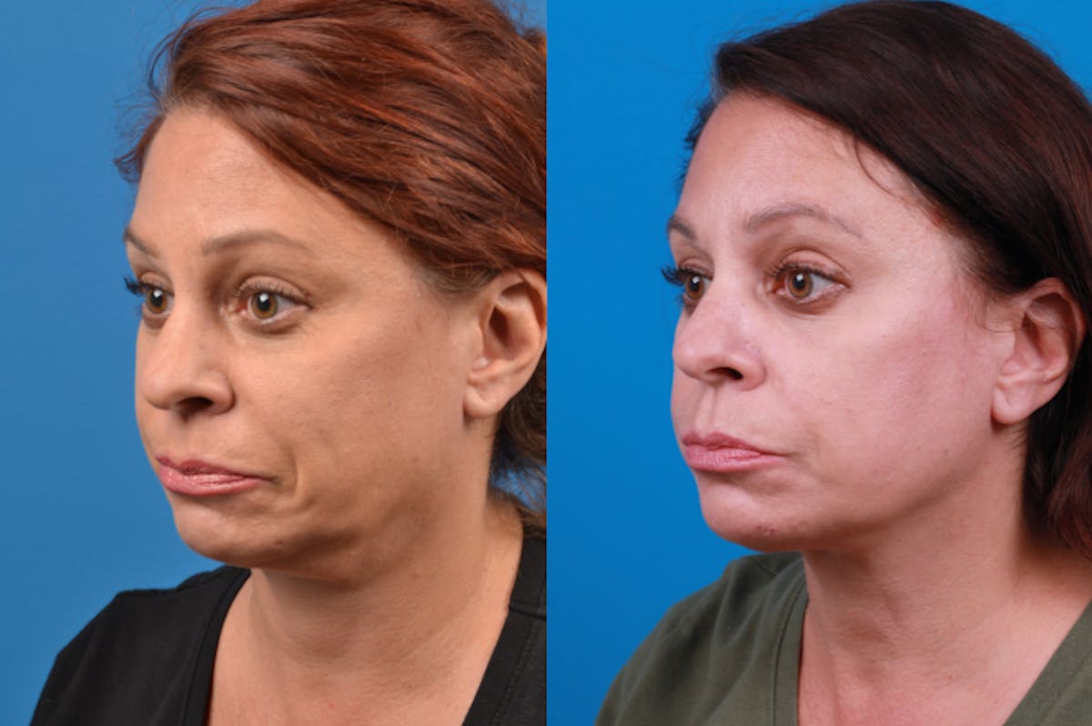 Profile Neck Lift Before & After Gallery - Patient 122406569 - Image 3