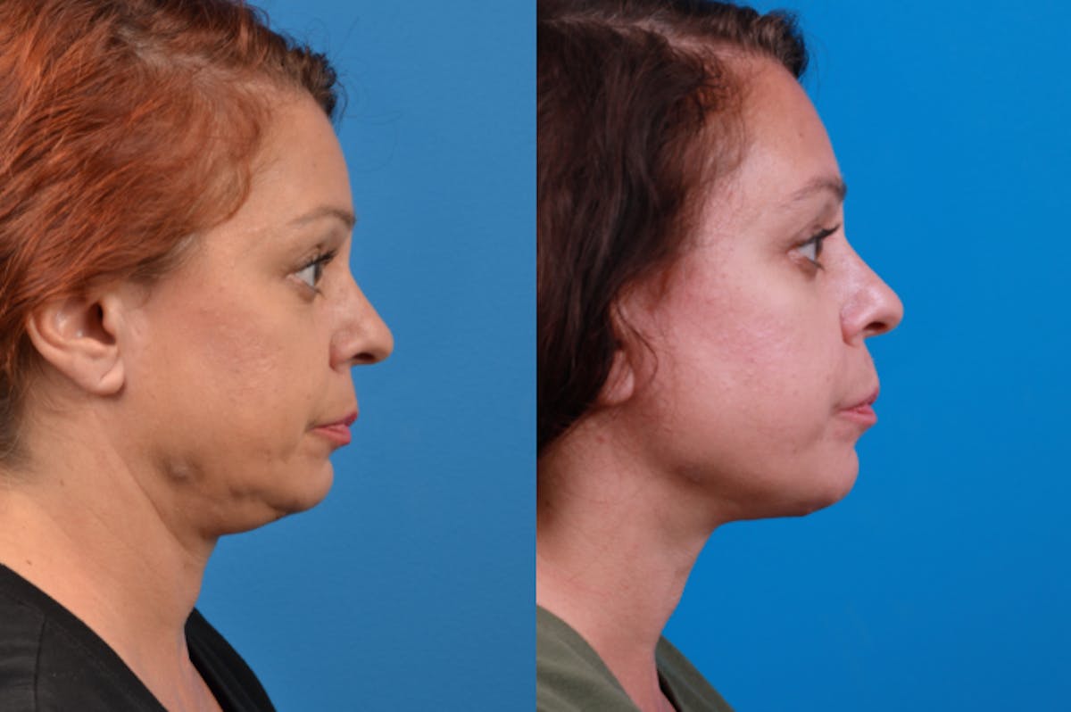 Profile Neck Lift Before & After Gallery - Patient 122406569 - Image 4
