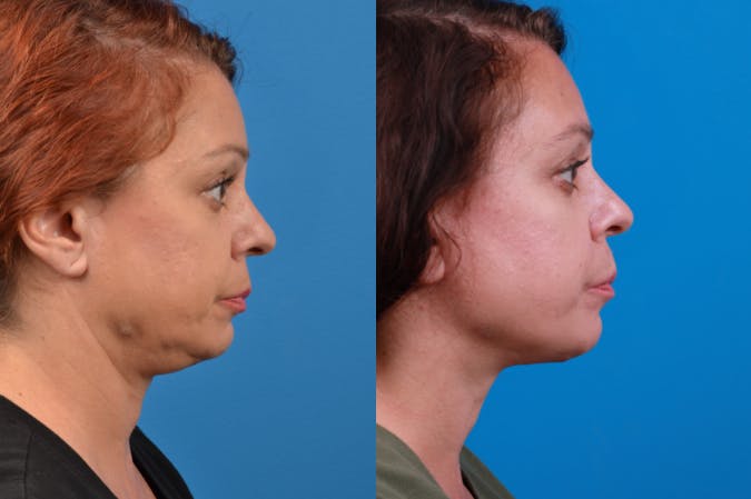 Profile Neck Lift Before & After Gallery - Patient 122406569 - Image 4