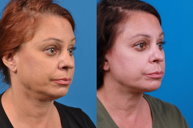 Profile Neck Lift Before & After Gallery - Patient 122406569 - Image 5