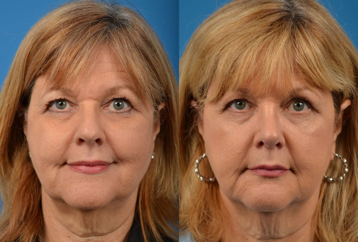 Rhinoplasty Before & After Gallery - Patient 122406570 - Image 3