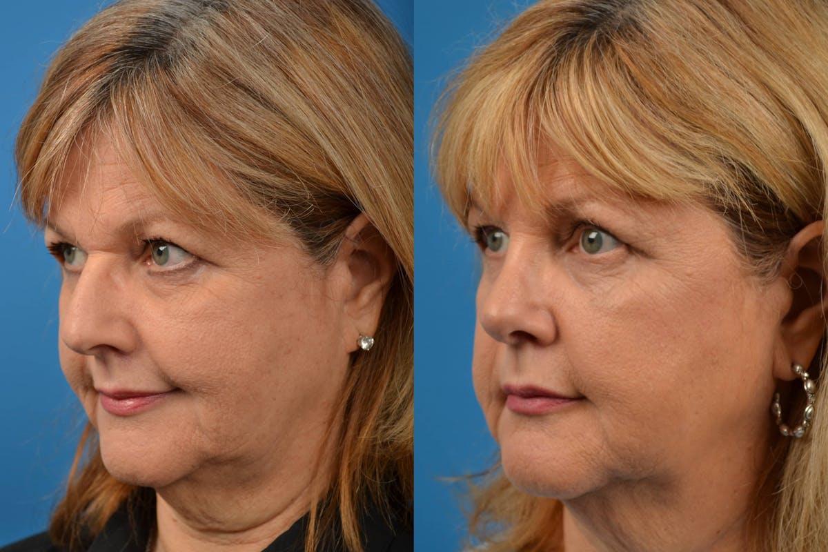 Rhinoplasty Before & After Gallery - Patient 122406570 - Image 4