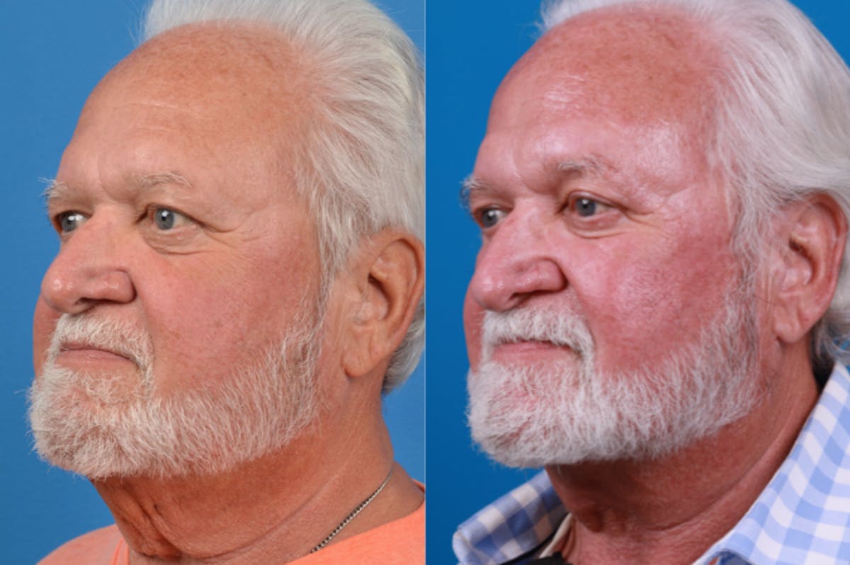 Profile Neck Lift Before & After Gallery - Patient 122406571 - Image 3
