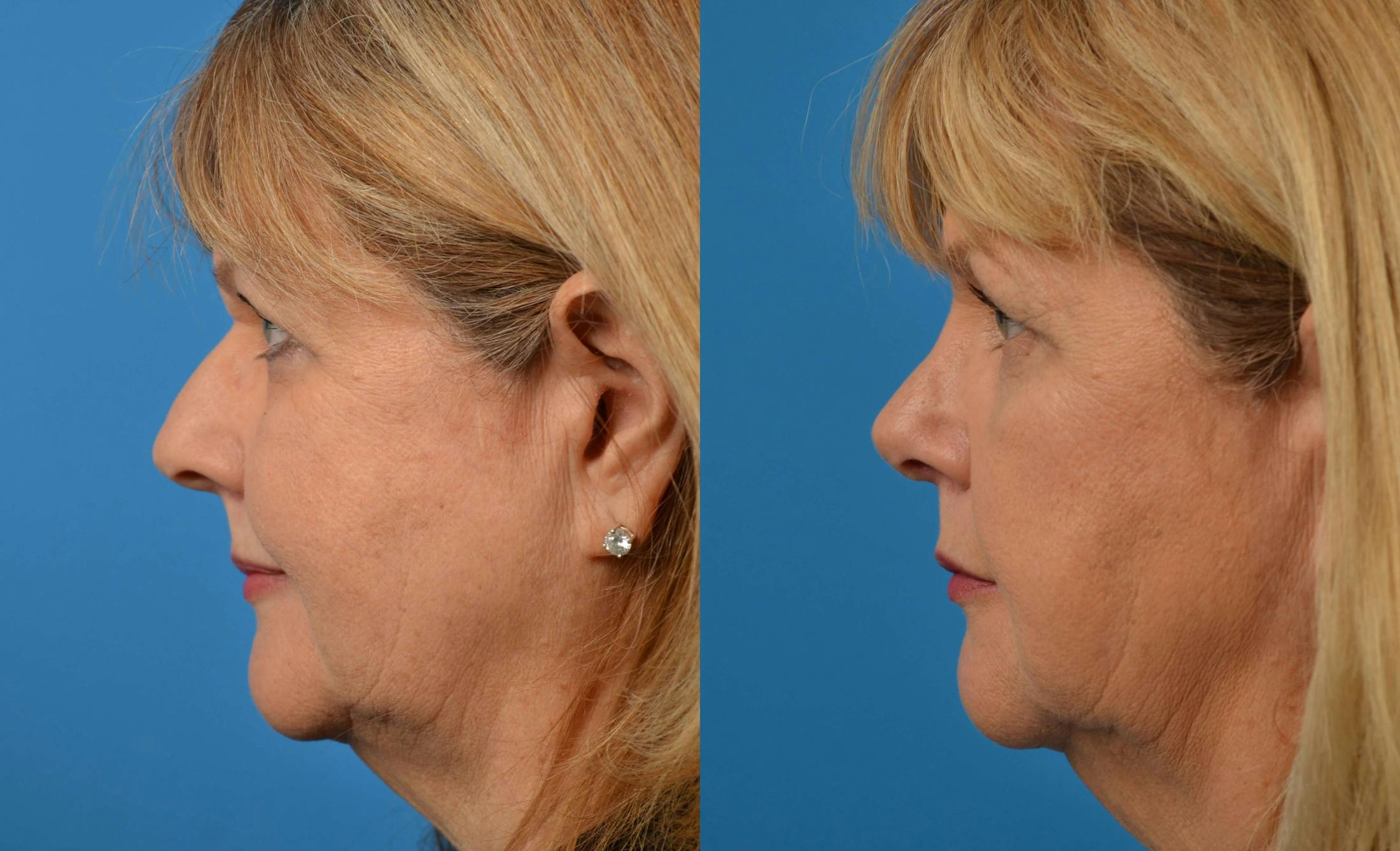 Rhinoplasty Before & After Gallery - Patient 122406570 - Image 5