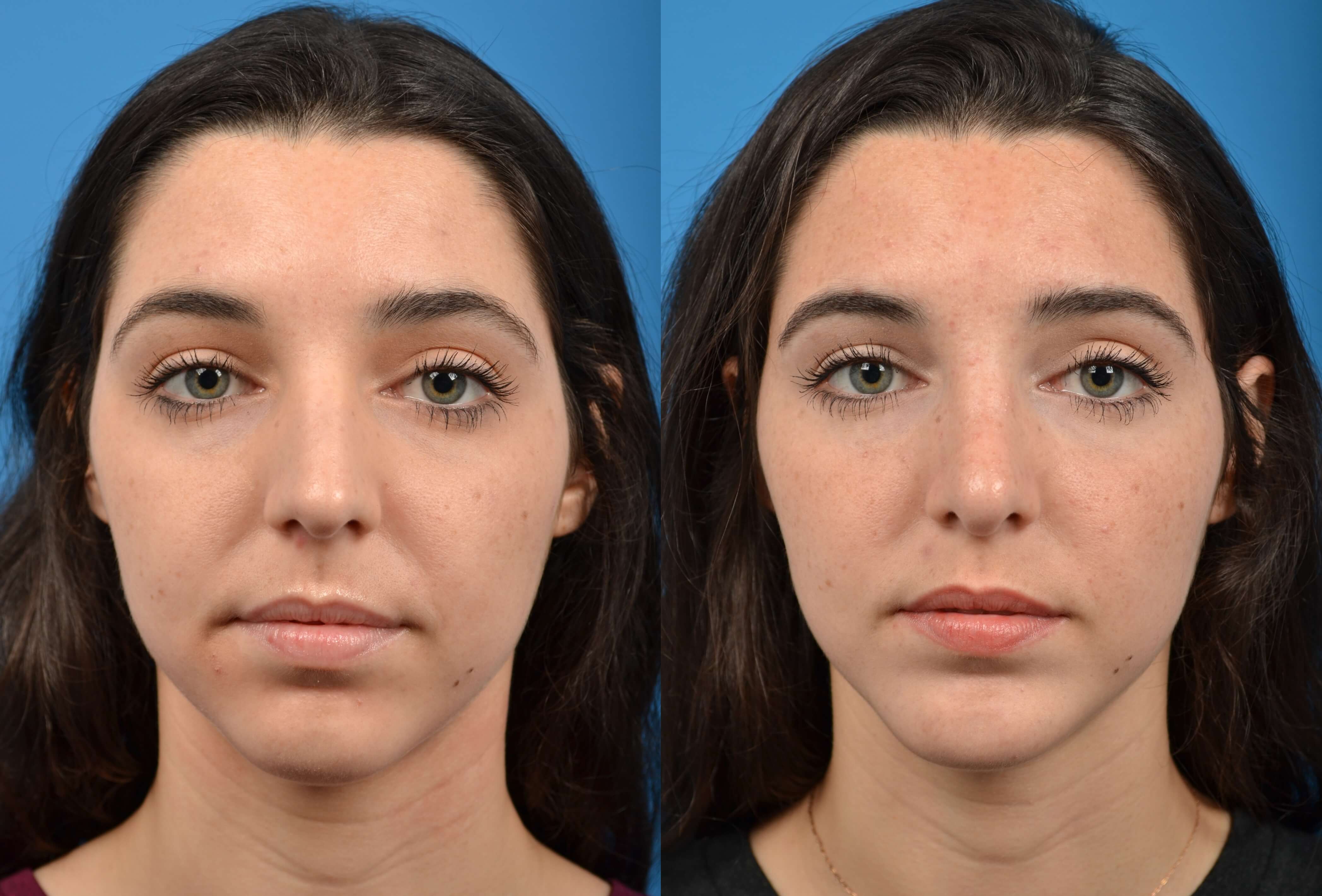 Rhinoplasty Before & After Gallery - Patient 122406572 - Image 3