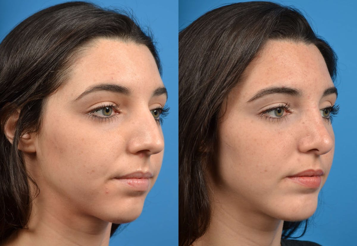 Rhinoplasty Before & After Gallery - Patient 122406572 - Image 4