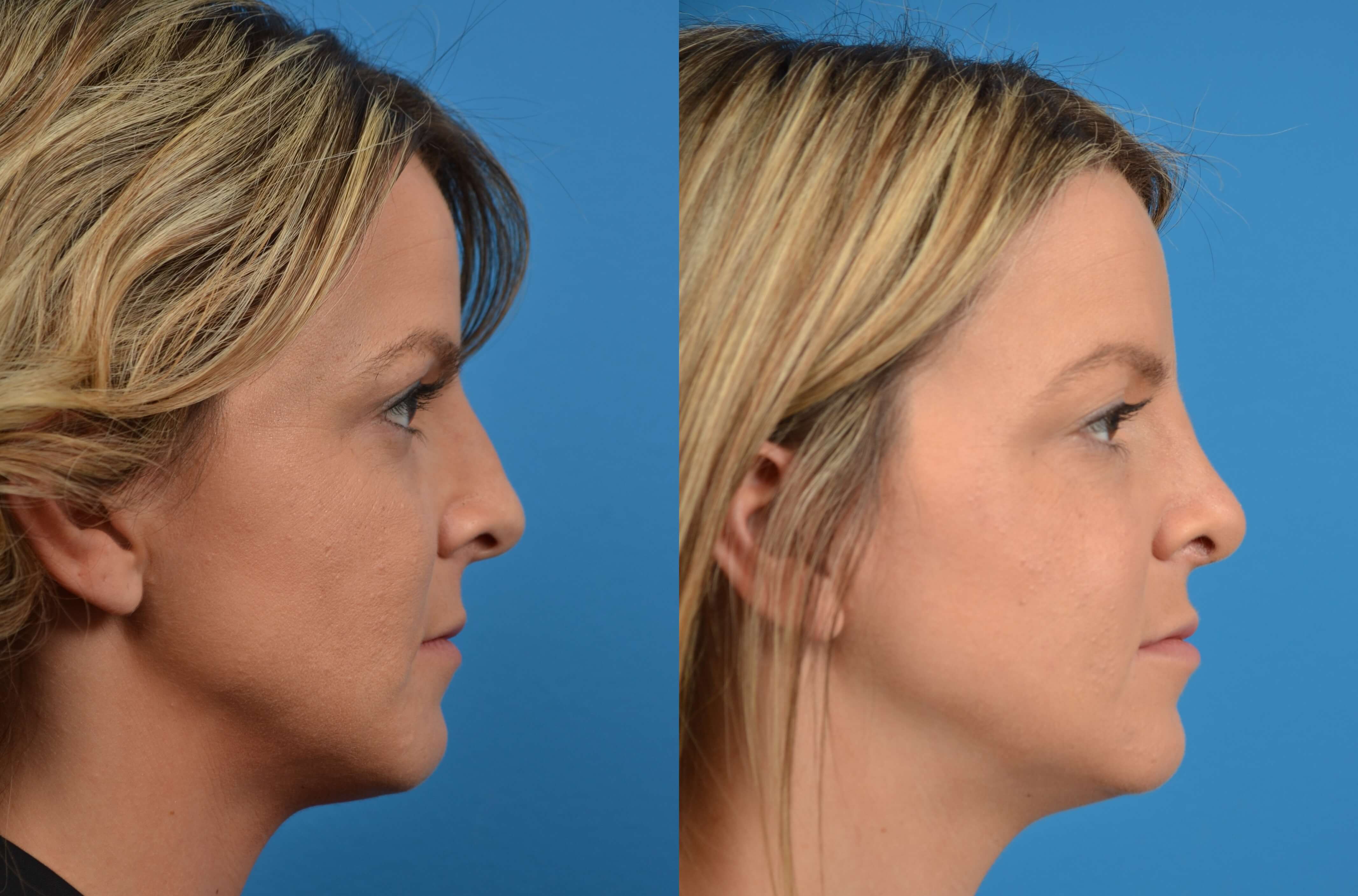 Rhinoplasty Before & After Gallery - Patient 122406575 - Image 1