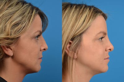 Rhinoplasty Before & After Gallery - Patient 122406575 - Image 1