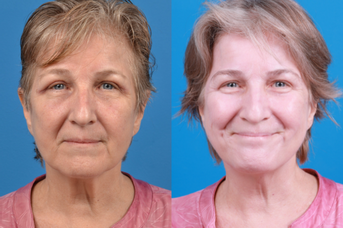 Profile Neck Lift Before & After Gallery - Patient 122406574 - Image 1