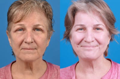 Profile Neck Lift Before & After Gallery - Patient 122406574 - Image 1