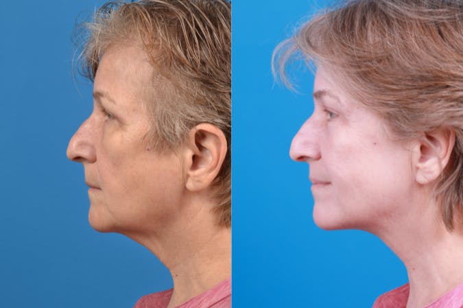 Profile Neck Lift Before & After Gallery - Patient 122406574 - Image 2