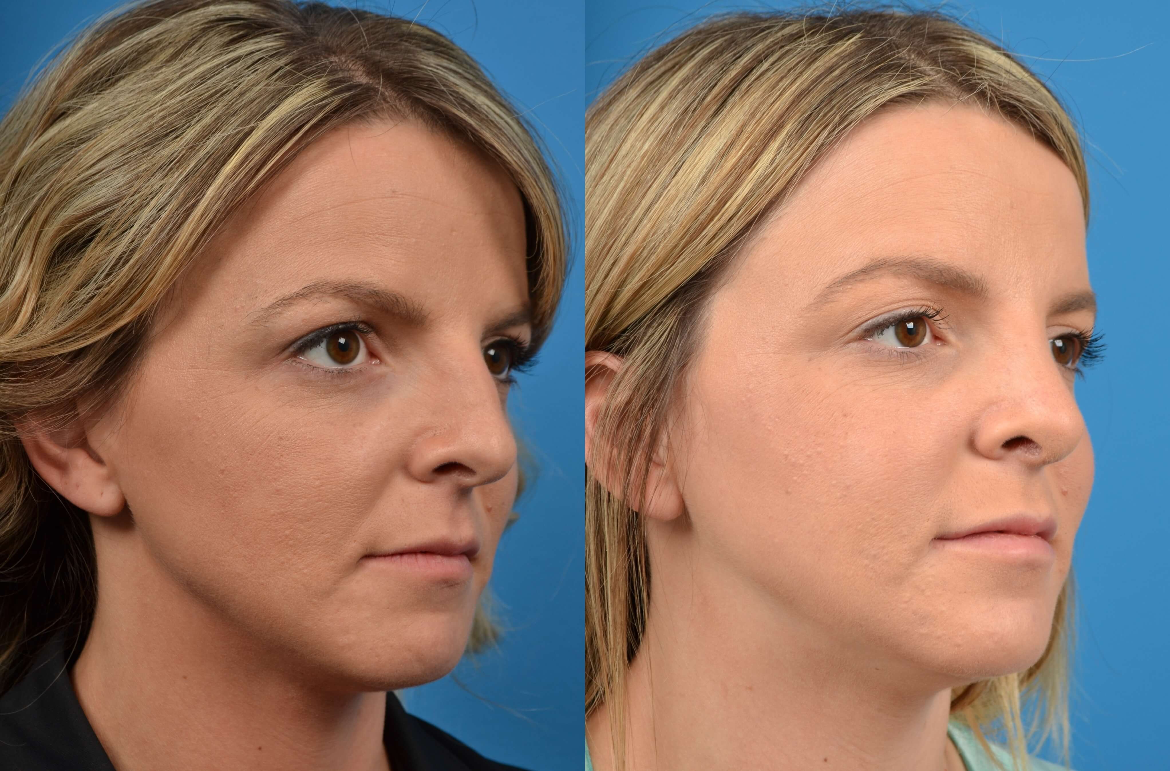 Rhinoplasty Before & After Gallery - Patient 122406575 - Image 2