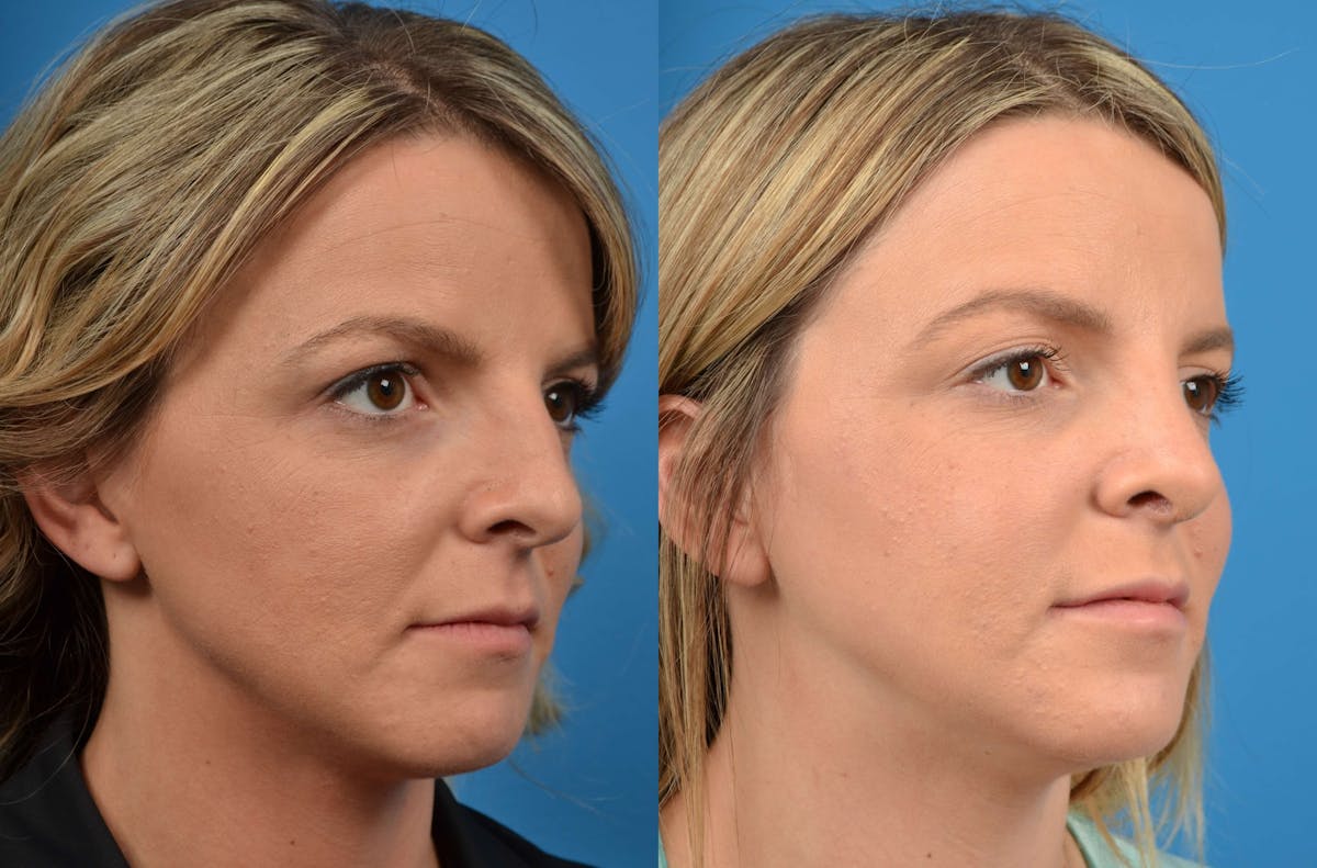 Rhinoplasty Before & After Gallery - Patient 122406575 - Image 2