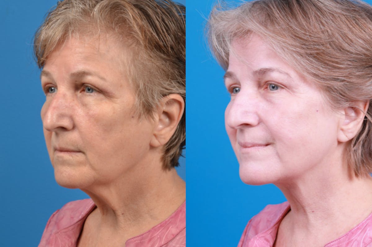 Profile Neck Lift Before & After Gallery - Patient 122406574 - Image 3