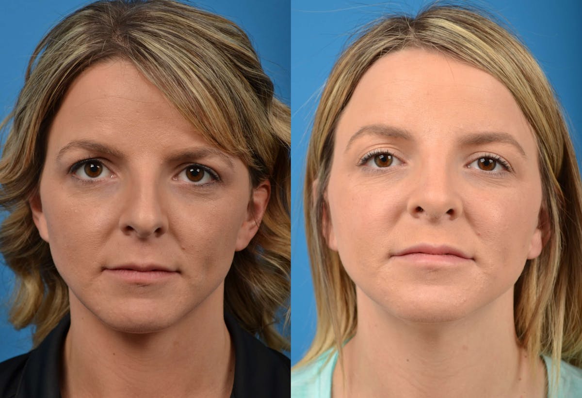 Rhinoplasty Before & After Gallery - Patient 122406575 - Image 3