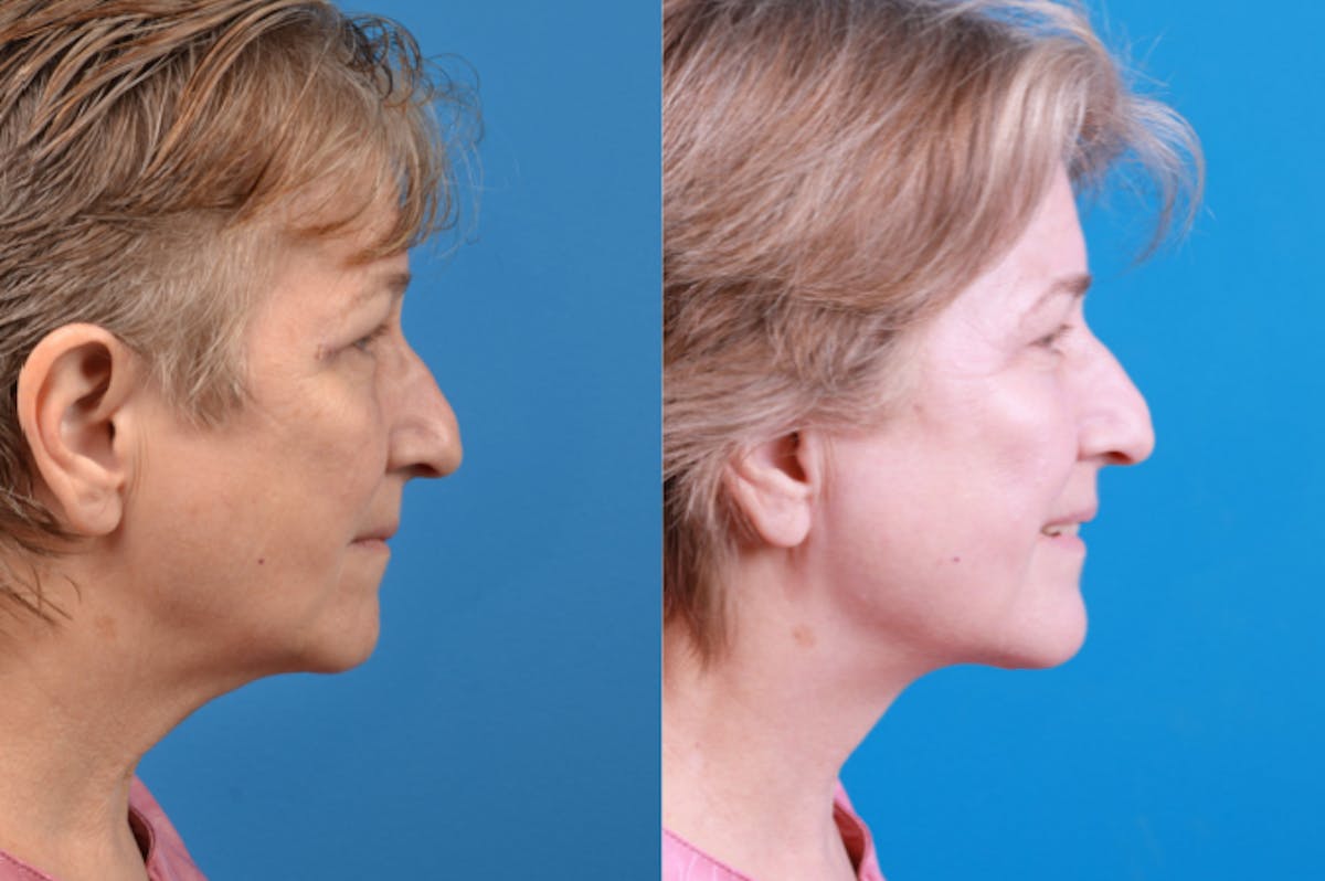 Profile Neck Lift Before & After Gallery - Patient 122406574 - Image 4
