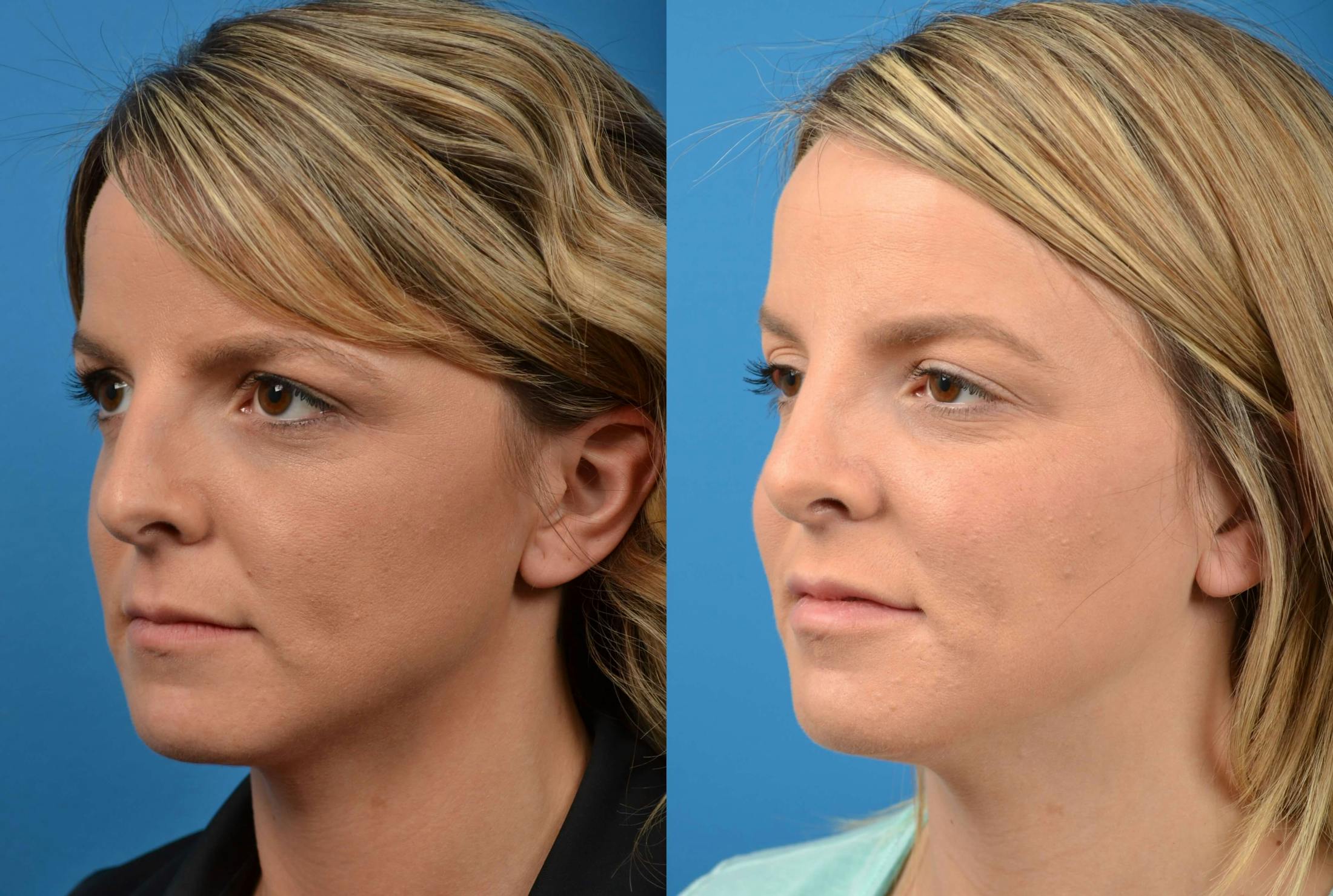 Rhinoplasty Before & After Gallery - Patient 122406575 - Image 4