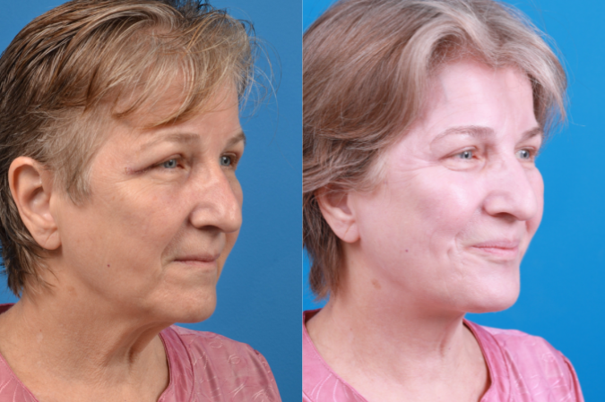 Profile Neck Lift Before & After Gallery - Patient 122406574 - Image 5
