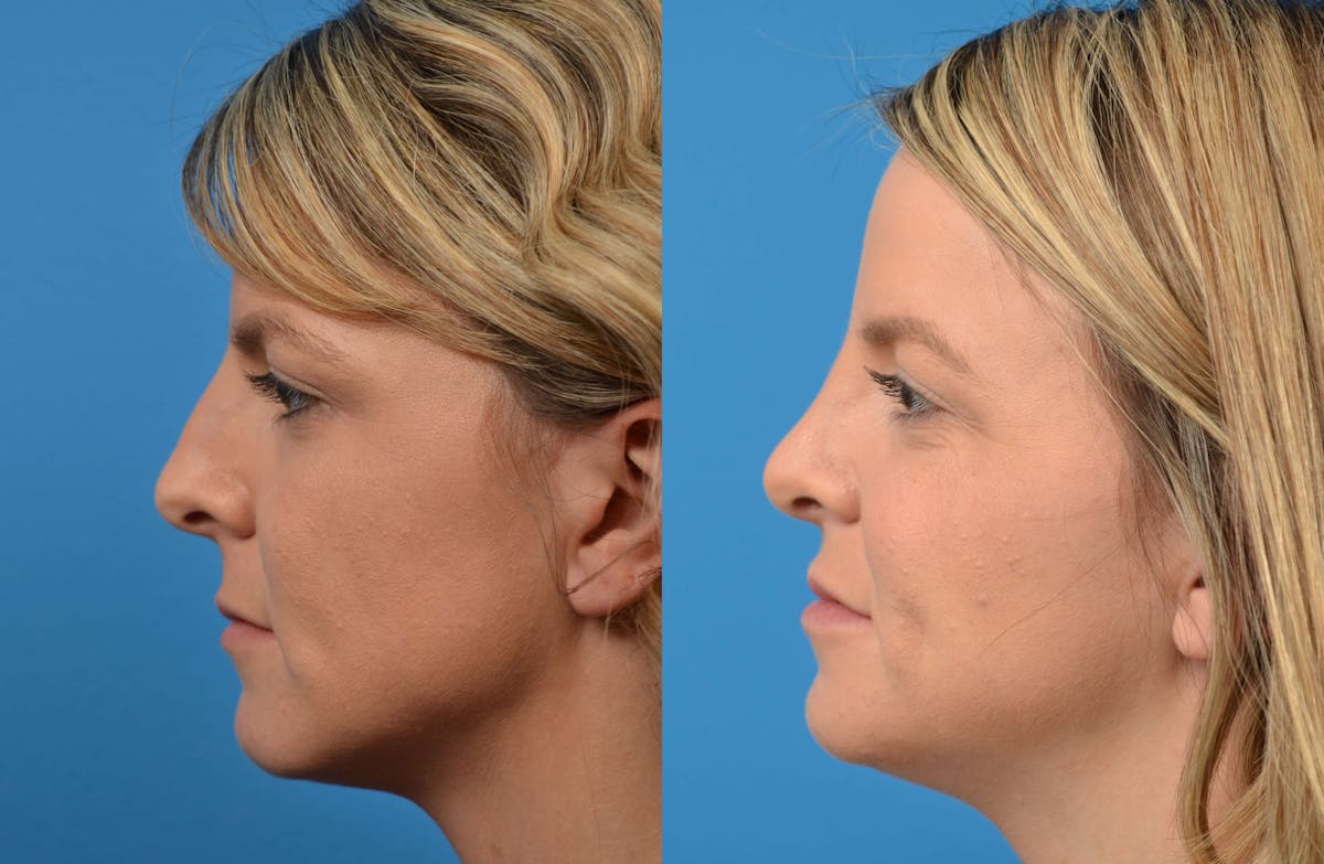 Rhinoplasty Before & After Gallery - Patient 122406575 - Image 5
