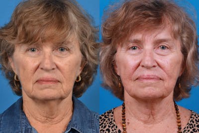 Profile Neck Lift Before & After Gallery - Patient 122406577 - Image 1