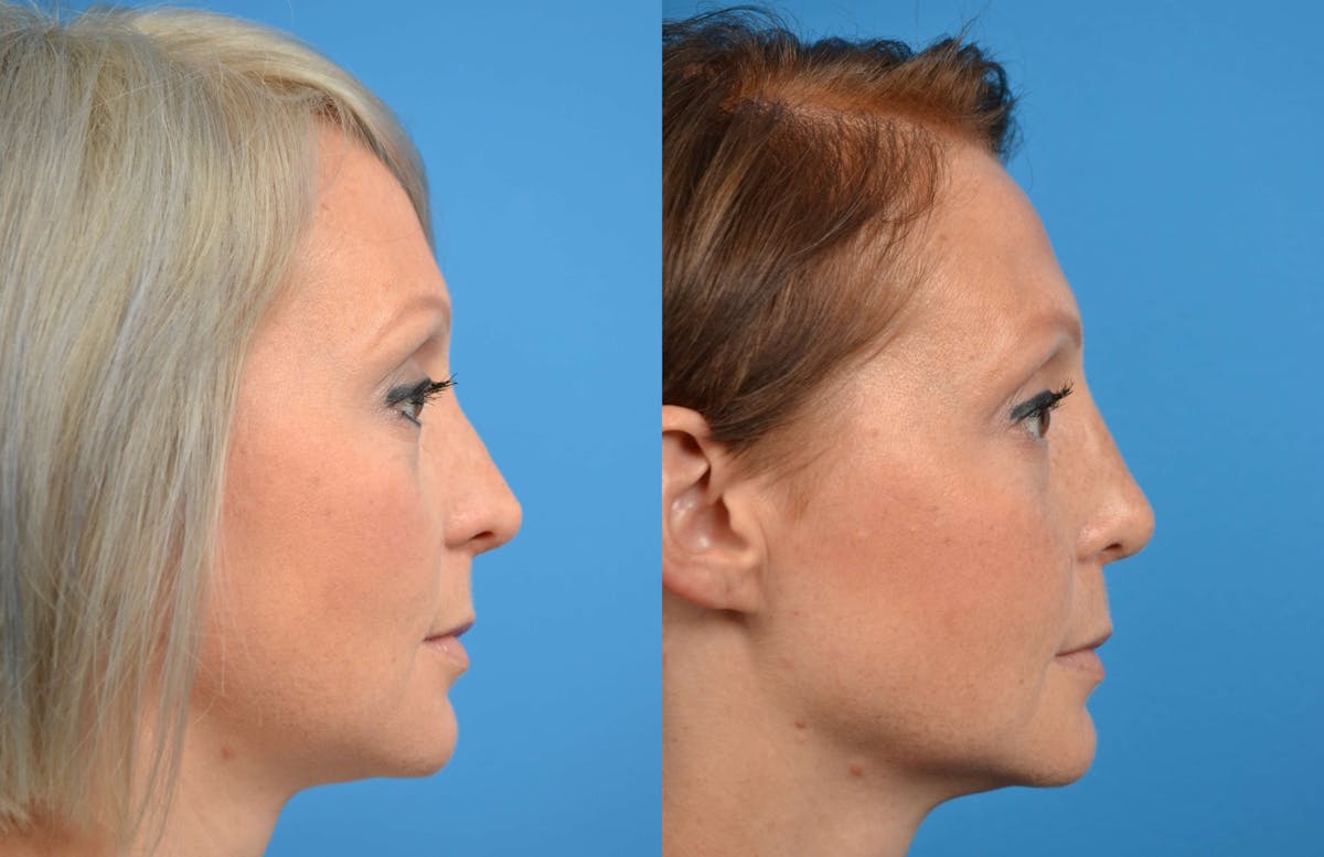 Rhinoplasty Before & After Gallery - Patient 122406576 - Image 1