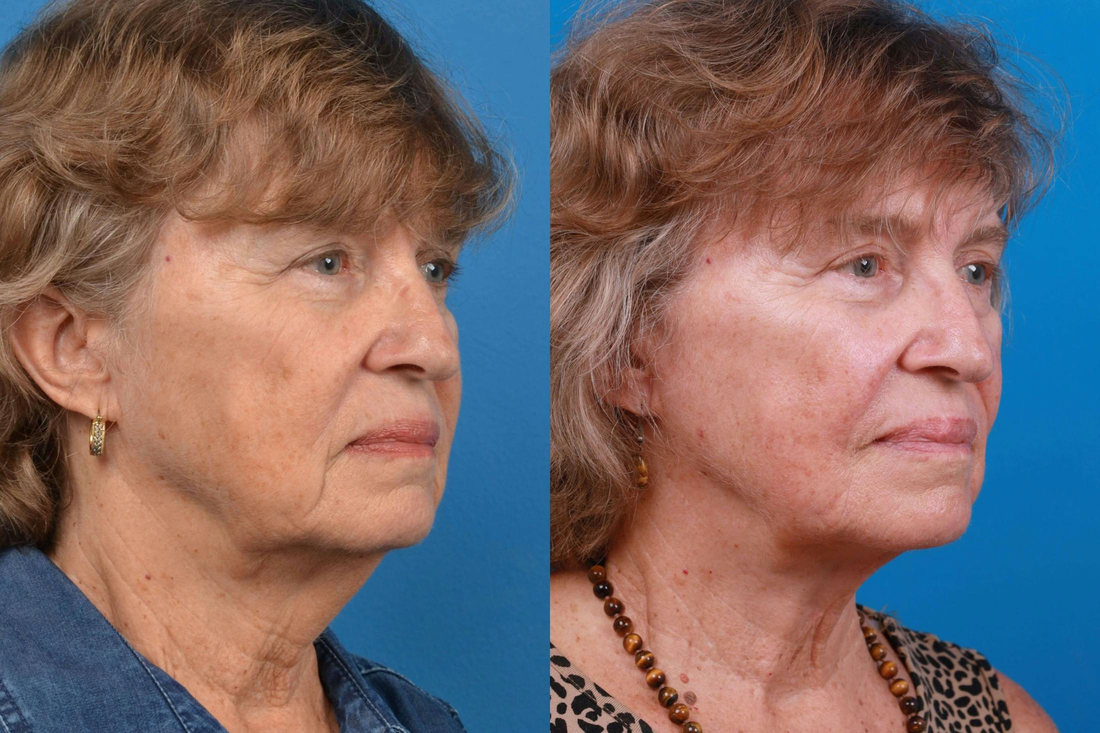 Profile Neck Lift Before & After Gallery - Patient 122406577 - Image 2