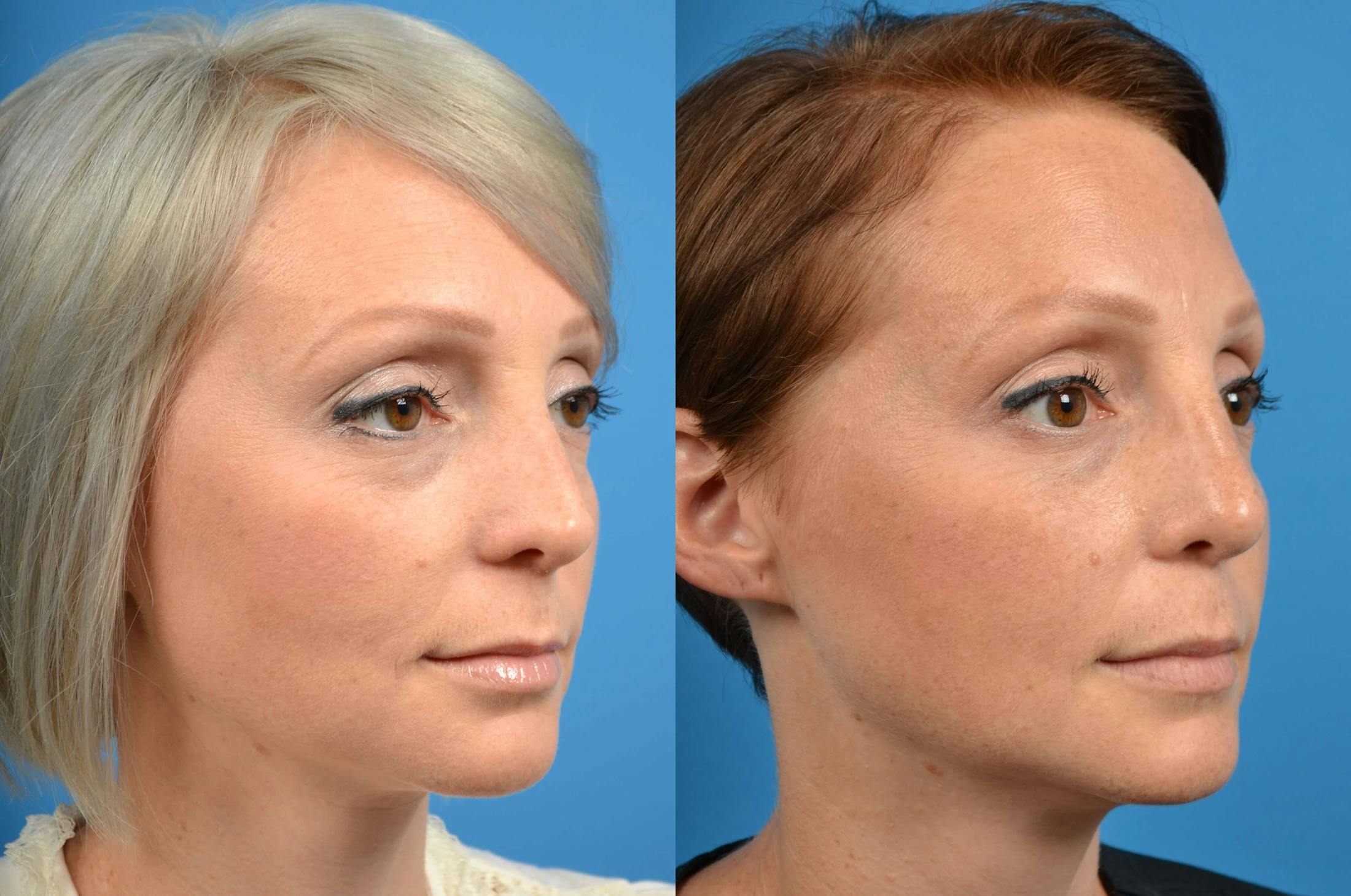 Rhinoplasty Before & After Gallery - Patient 122406576 - Image 2