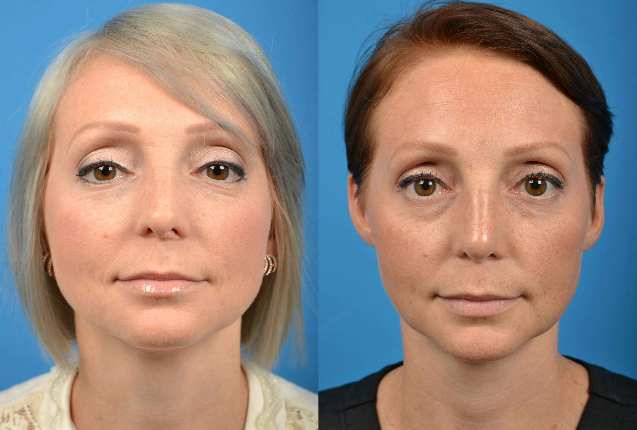 Rhinoplasty Before & After Gallery - Patient 122406576 - Image 3