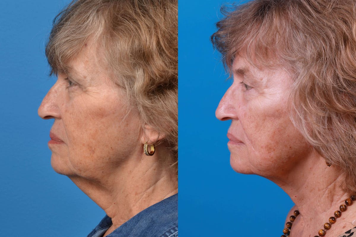 Profile Neck Lift Before & After Gallery - Patient 122406577 - Image 3