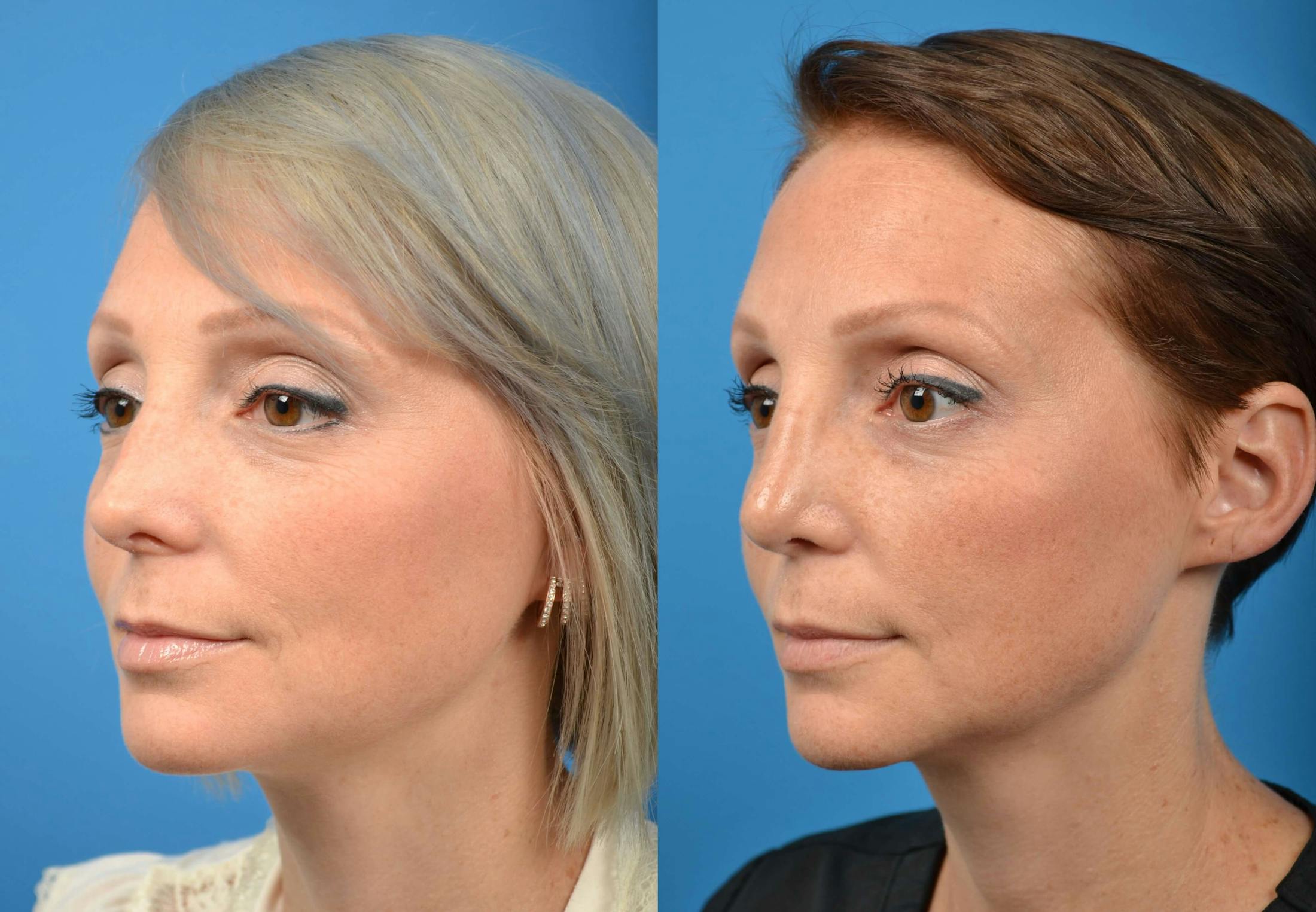 Rhinoplasty Before & After Gallery - Patient 122406576 - Image 4