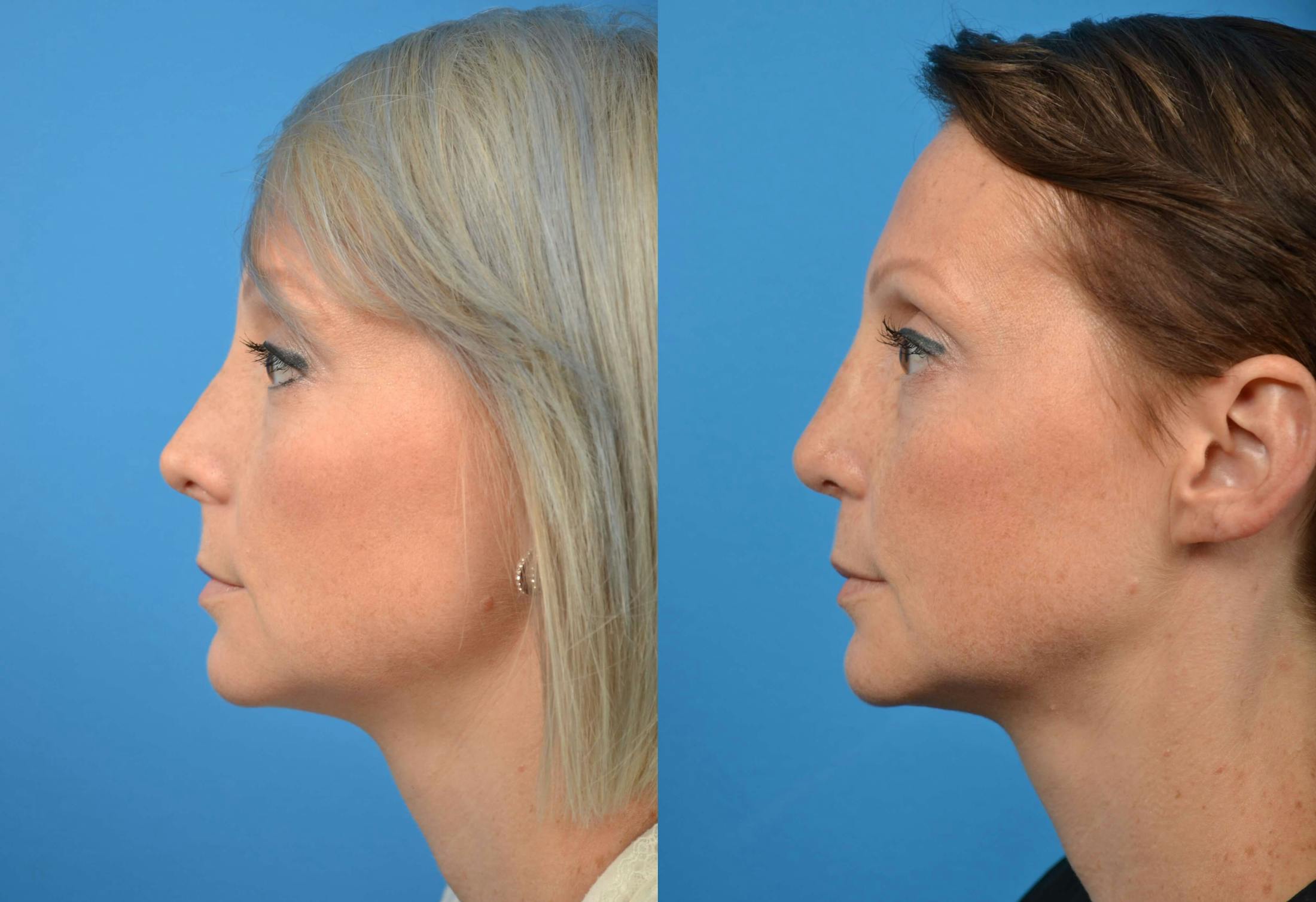Rhinoplasty Before & After Gallery - Patient 122406576 - Image 5