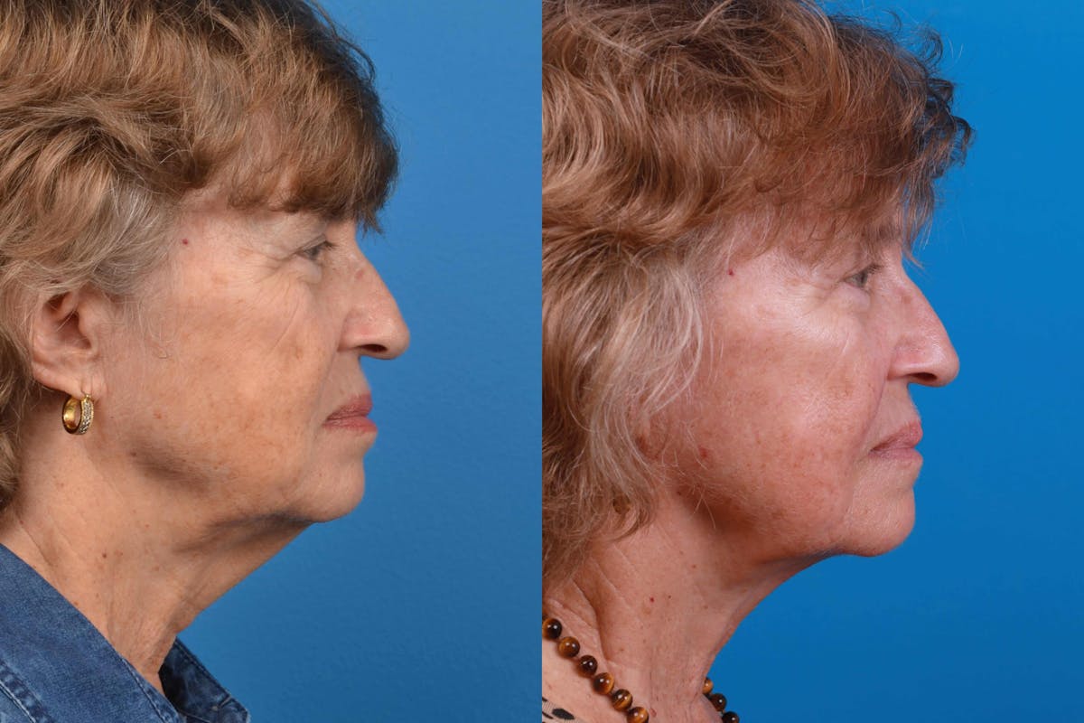 Profile Neck Lift Before & After Gallery - Patient 122406577 - Image 4