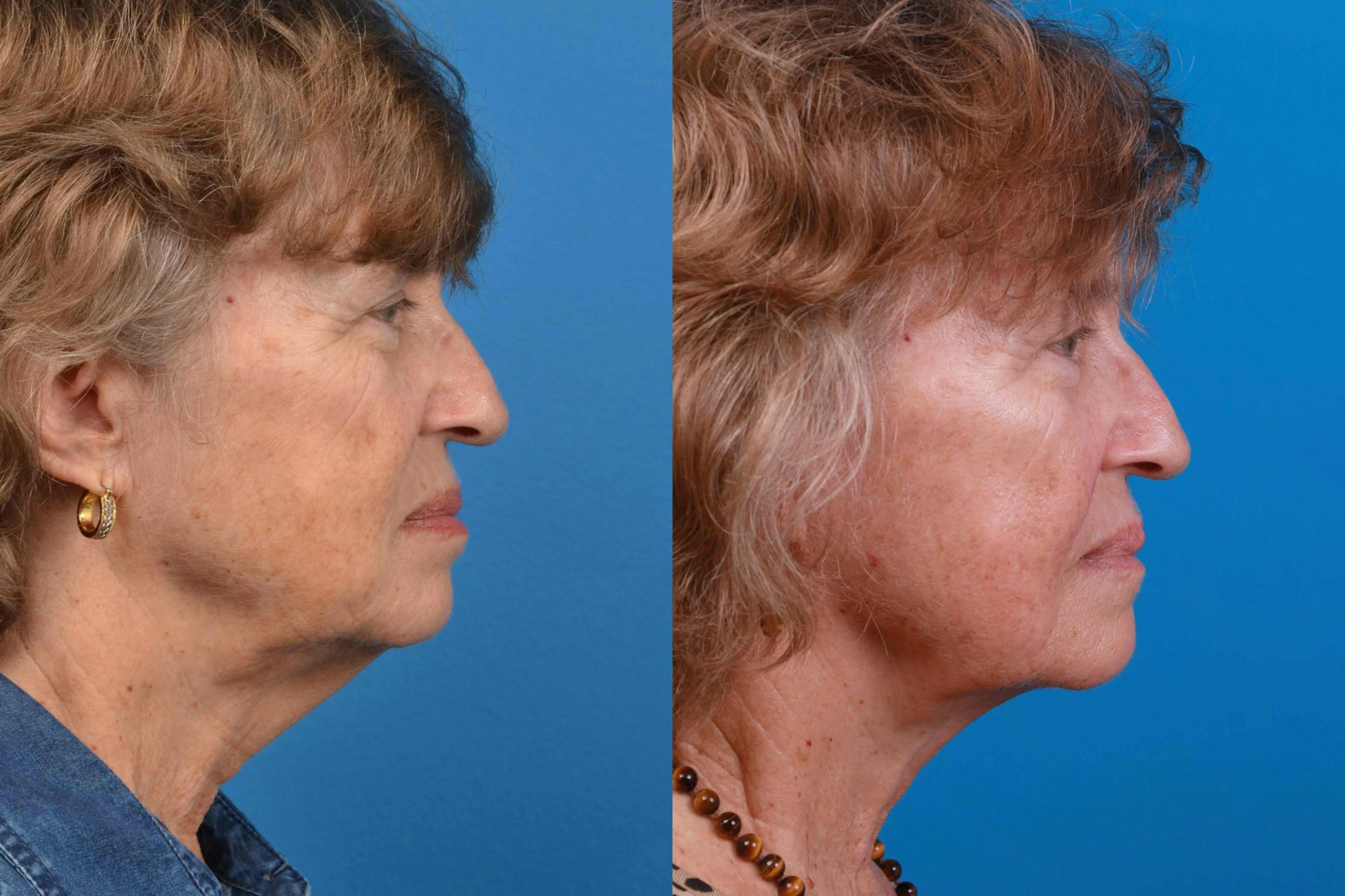 Profile Neck Lift Before & After Gallery - Patient 122406577 - Image 4