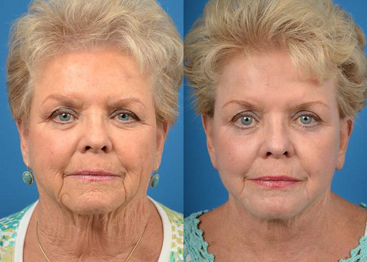 Skin Resurfacing Before & After Gallery - Patient 122406579 - Image 1