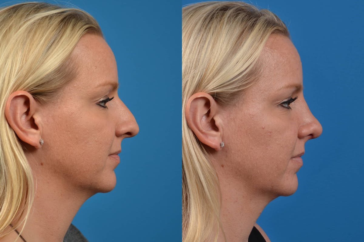 Rhinoplasty Before & After Gallery - Patient 122406583 - Image 1