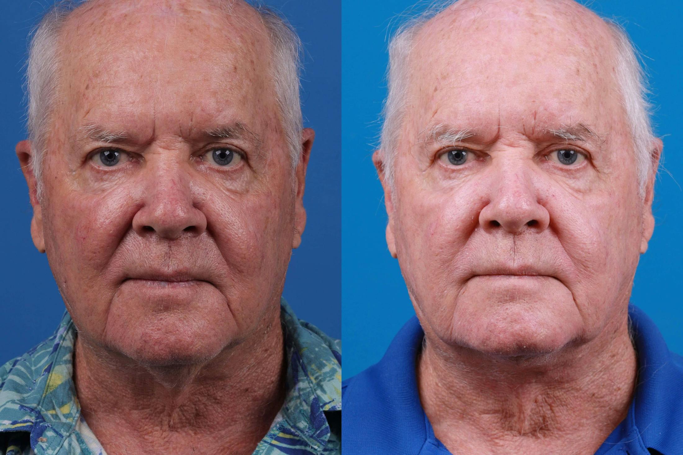 Profile Neck Lift Before & After Gallery - Patient 122406580 - Image 1