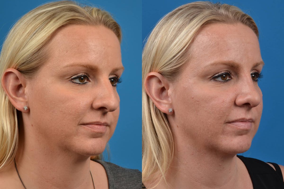 Rhinoplasty Before & After Gallery - Patient 122406583 - Image 2