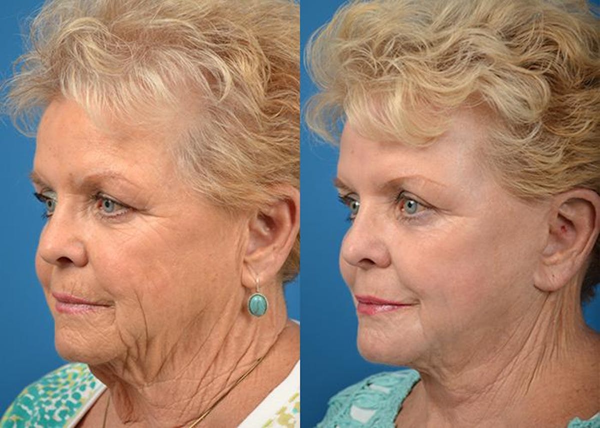 Skin Resurfacing Before & After Gallery - Patient 122406579 - Image 3