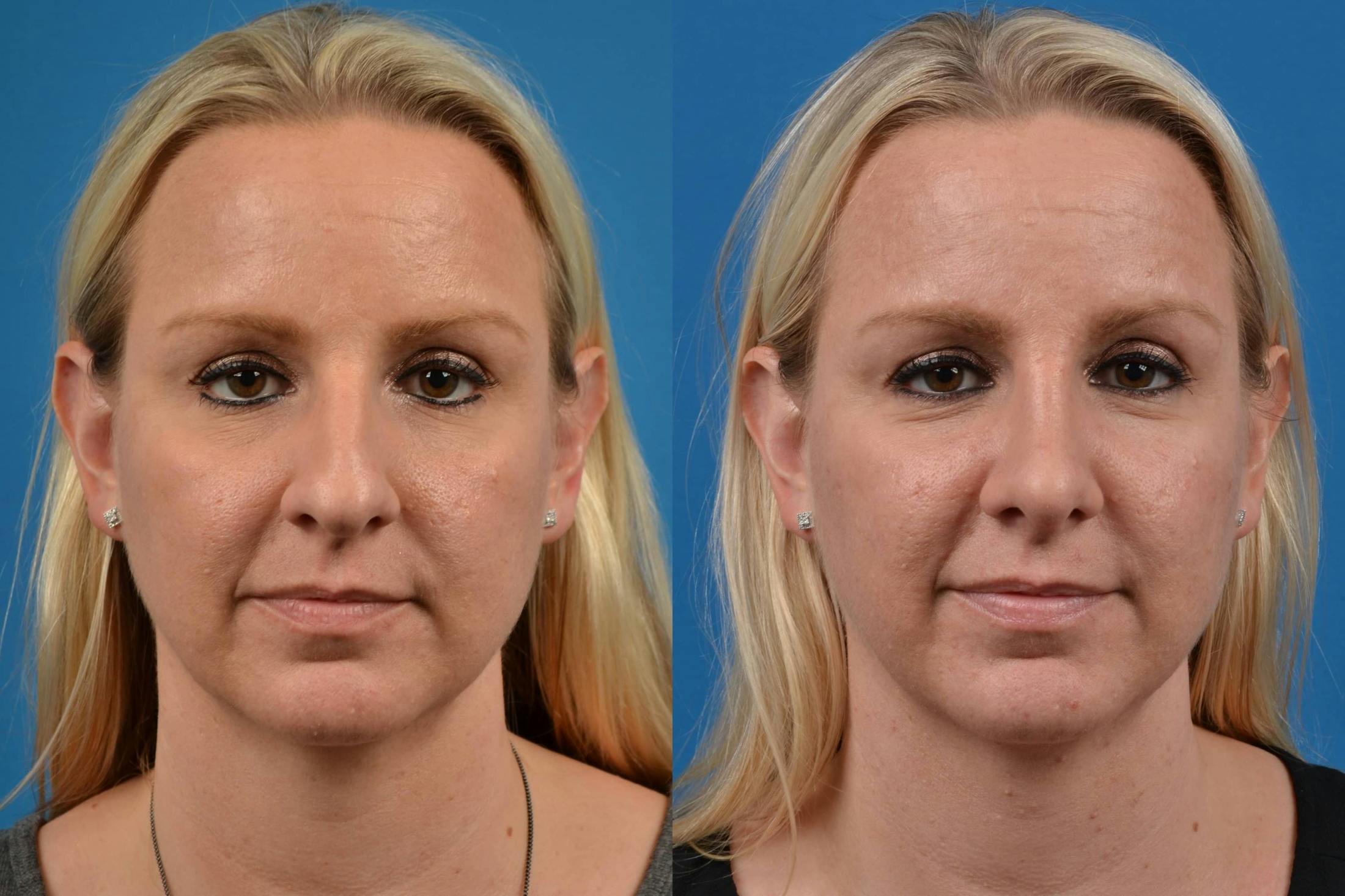 Rhinoplasty Before & After Gallery - Patient 122406583 - Image 3