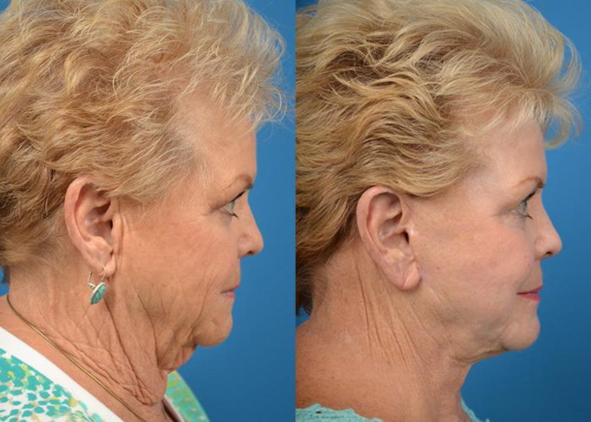 Skin Resurfacing Before & After Gallery - Patient 122406579 - Image 5