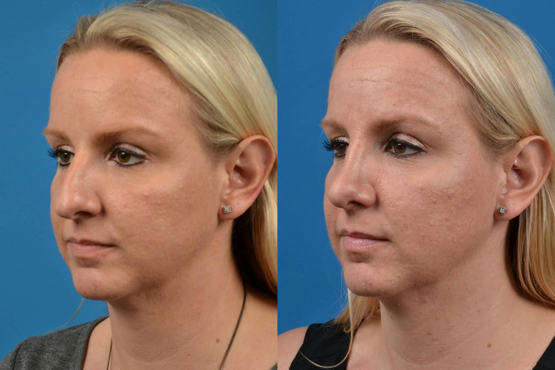 Rhinoplasty Before & After Gallery - Patient 122406583 - Image 4