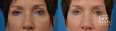 Eyelid Surgery Before & After Gallery - Patient 388650 - Image 1