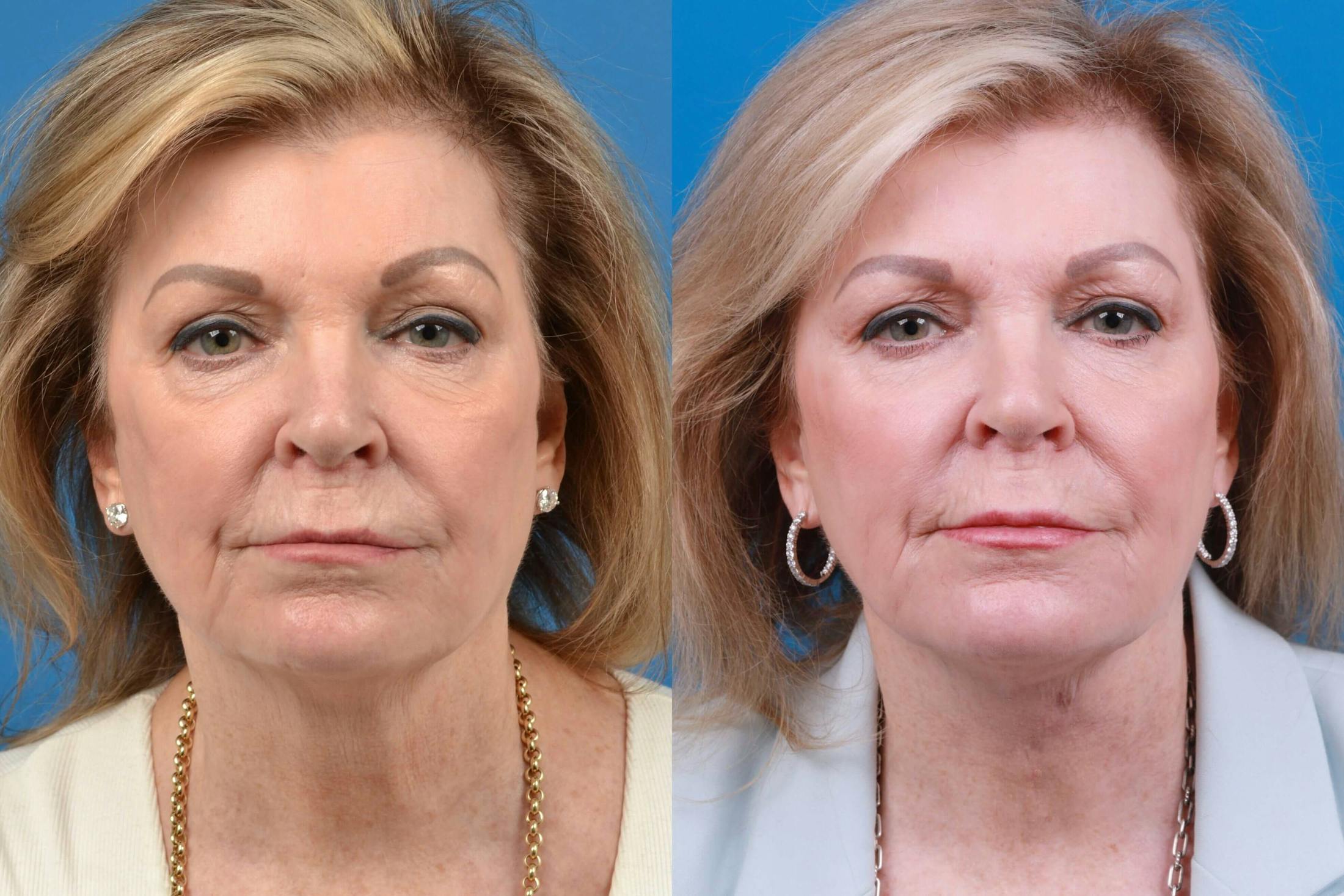 Profile Neck Lift Before & After Gallery - Patient 122406582 - Image 1