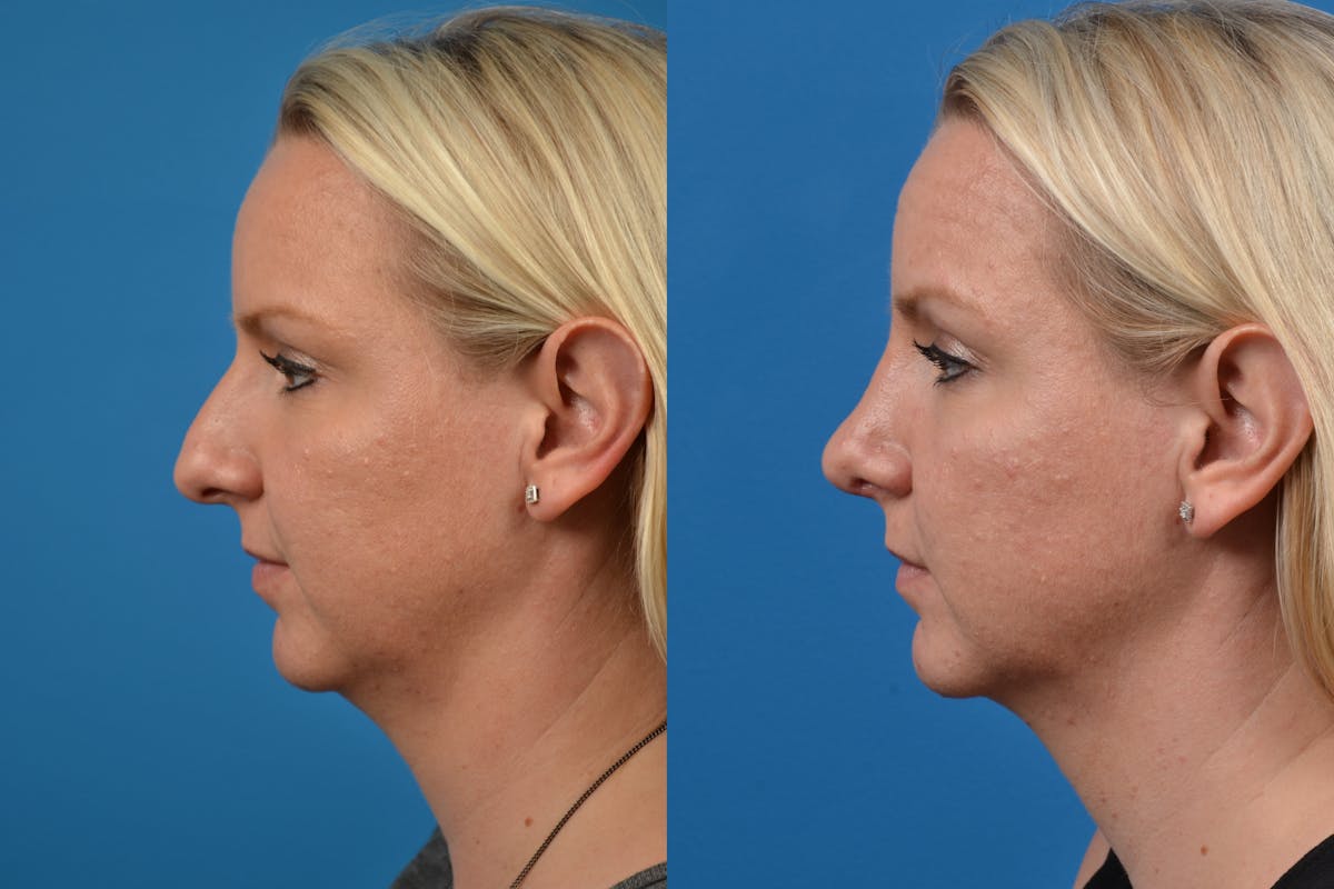 Rhinoplasty Before & After Gallery - Patient 122406583 - Image 5