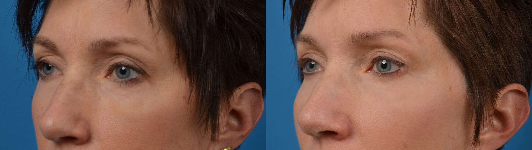 Skin Resurfacing Before & After Gallery - Patient 122406581 - Image 2