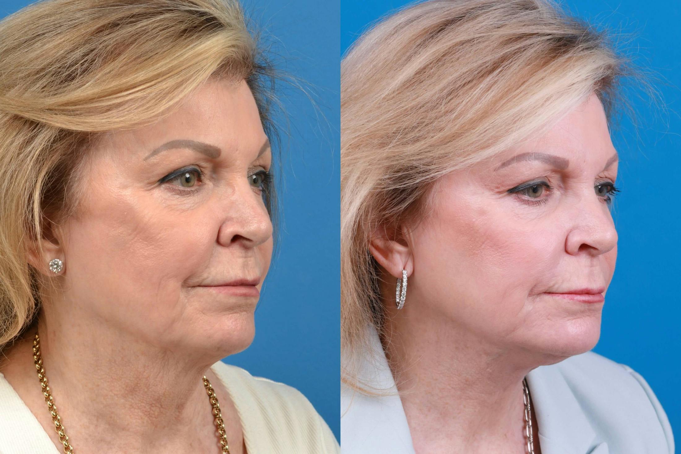 Profile Neck Lift Before & After Gallery - Patient 122406582 - Image 2